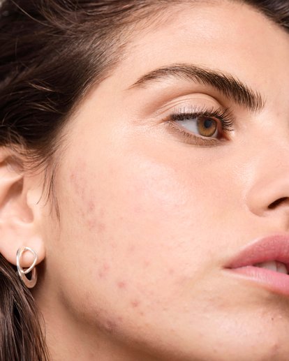 is-there-a-relationship-between-dairy-products-and-acne