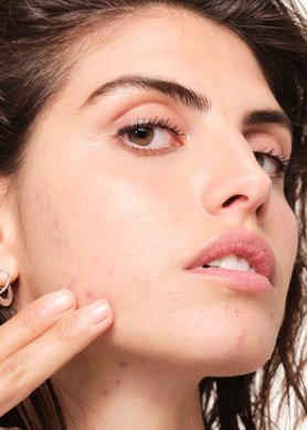 can-food-cause-acne