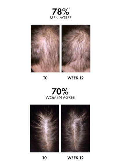 Vichy-Website-PDP-Regen-3337875896443-Content-block-Before-After-mobile